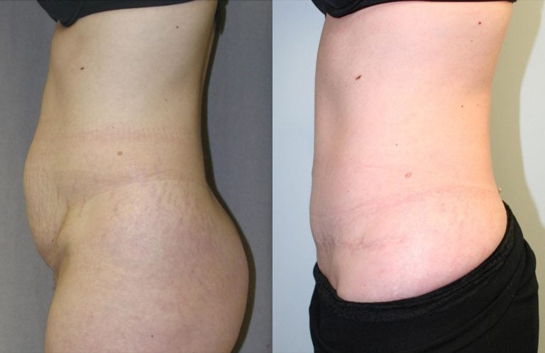Abdominoplasty - Before & After Results 40