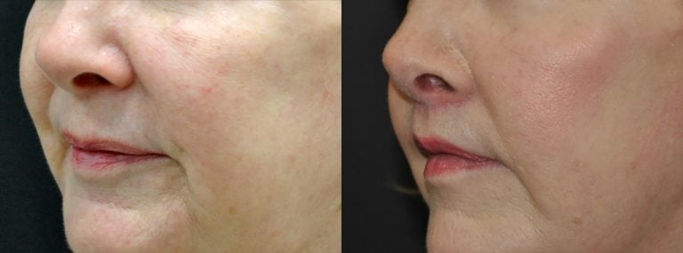 64 year-old patient, lip lift