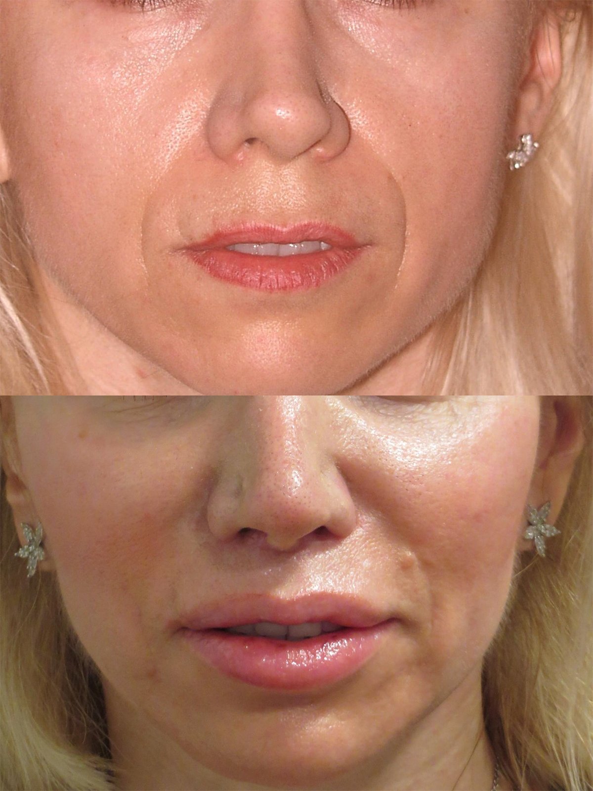 54 year-old patient, lip lift and fat injections to lips