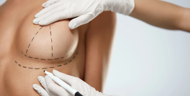 Similtaneous Areolar Mastopexy, Breast Augmentation