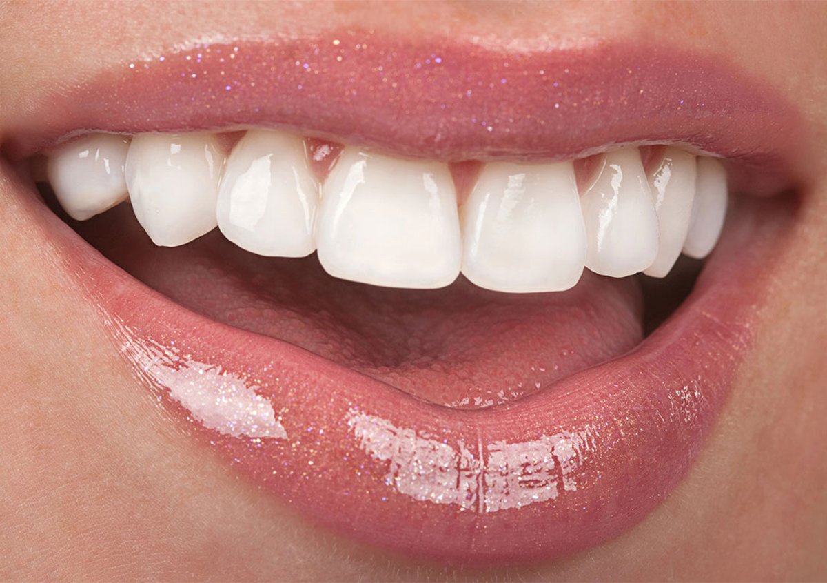 Upper Lip Shortening in Norwalk CT Area