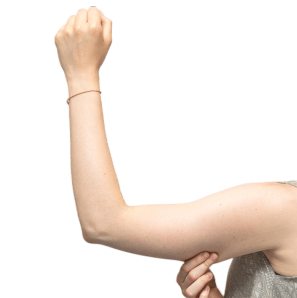 What is an Arm Lift?