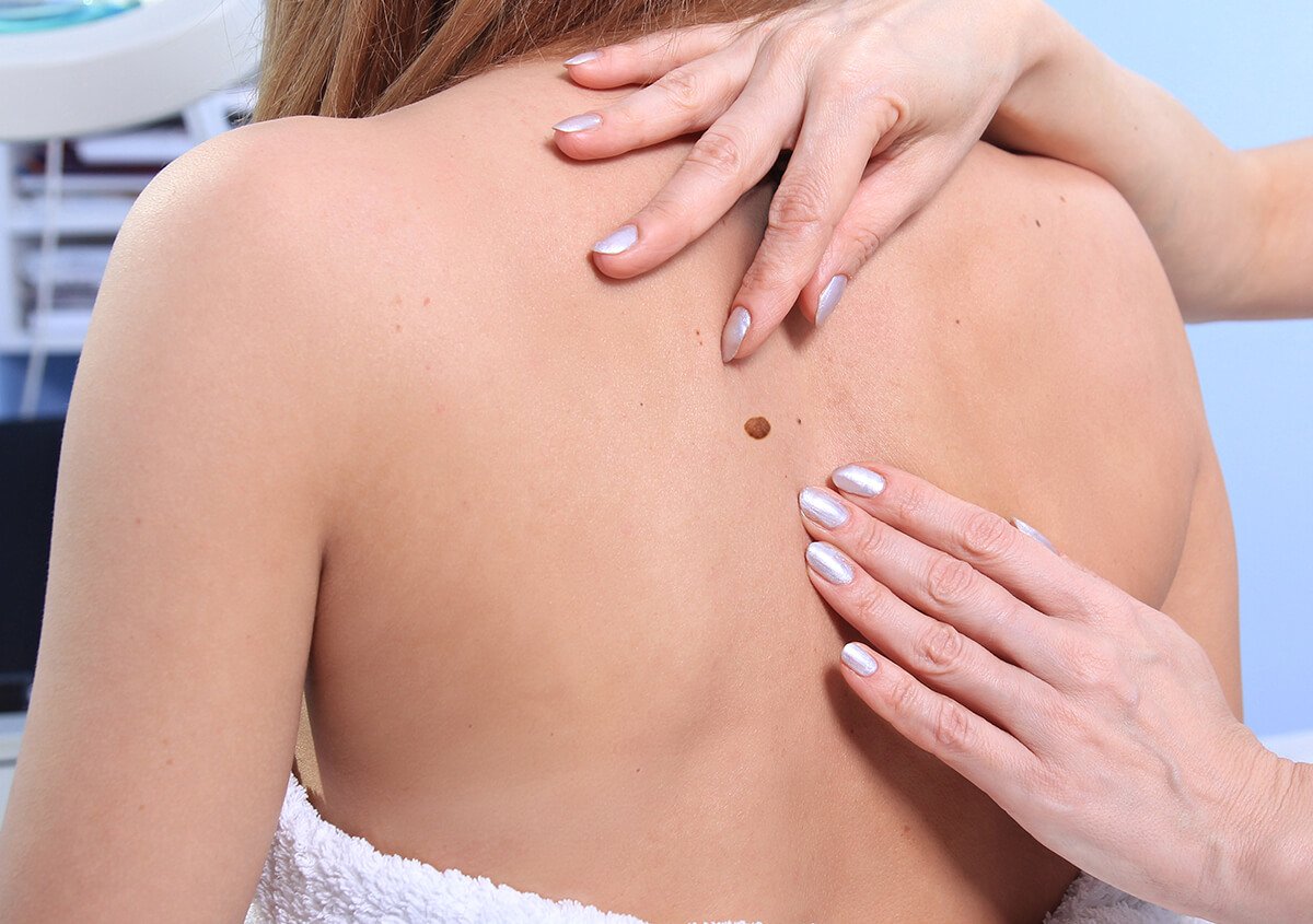 Mohs Surgery in Norwalk CT Area