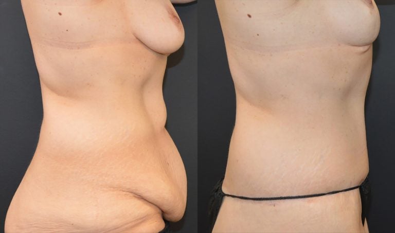 54-year-old 12 months after breast lift, 9 months after lower body lift & abdominoplasty, right side