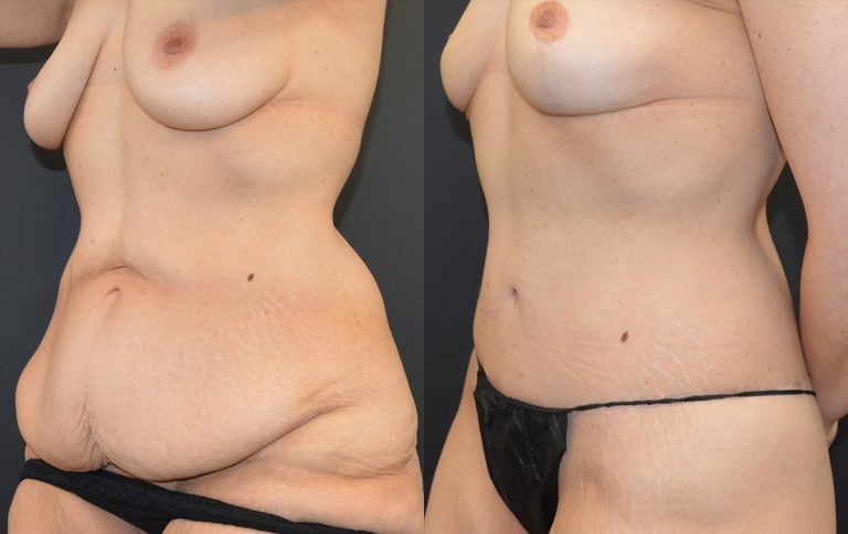 54-year-old 12 months after breast lift, 9 months after lower body lift & abdominoplasty, oblique left