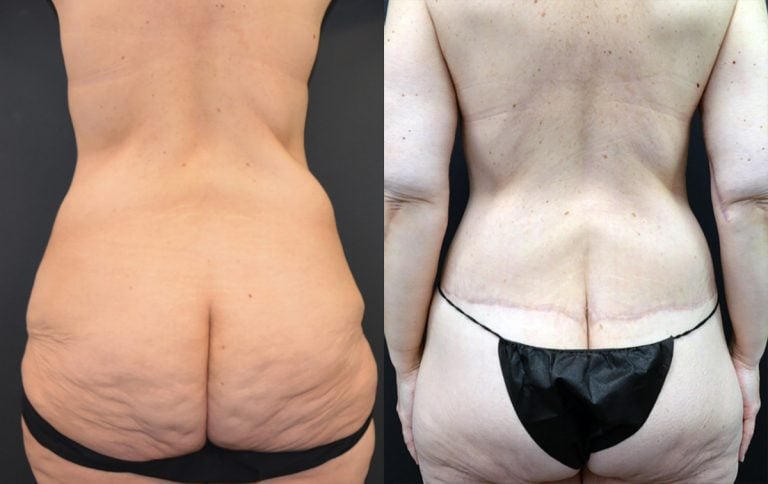 54-year-old 9 months after lower body lift & abdominoplasty, back