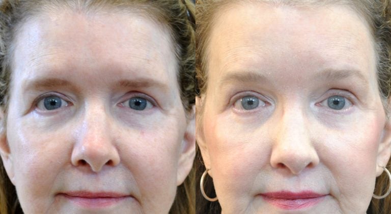 64-year-old 5 months after endoscopic brow lift with endotines. Front.