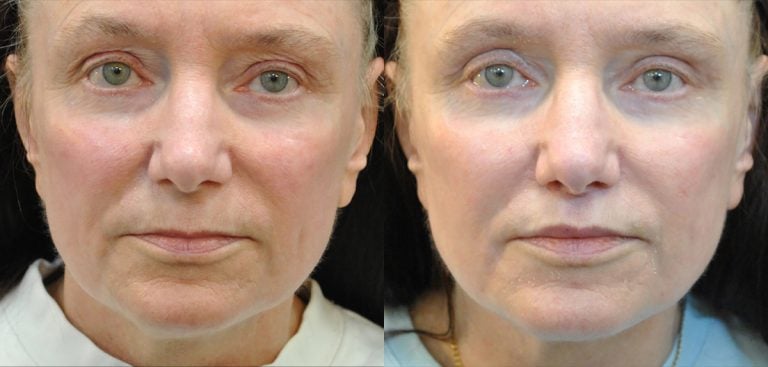 60-year-old 7 weeks after lip lift and fat injection to lips, upper lid blepharoplasty and FaceTite to lower face and neck, front.