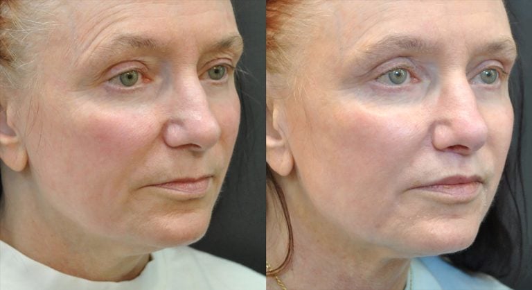 60-year-old 7 weeks after lip lift and fat injection to lips, upper lid blepharoplasty and FaceTite to lower face and neck, oblique.