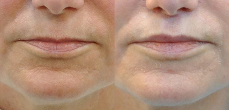 60-year-old 7 weeks after lip lift and fat injection to lip, front.