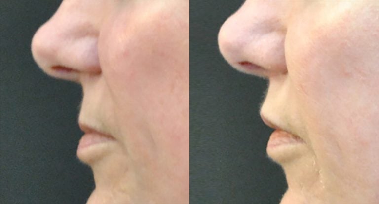 60-year-old 7 weeks after lip lift and fat injection to lip, side.