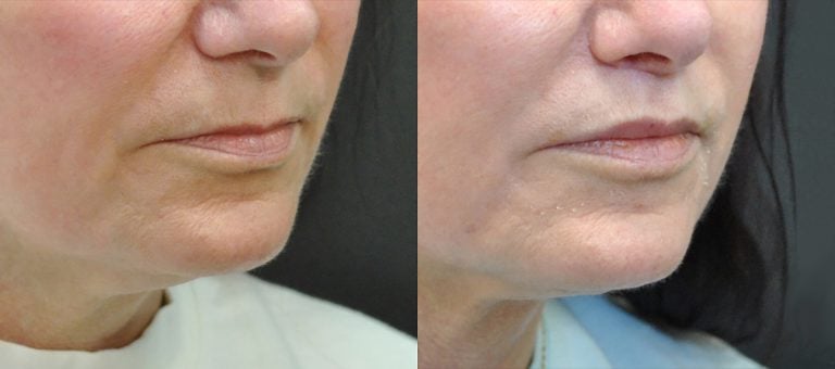 60-year-old 7 weeks after lip lift and fat injection to lips
