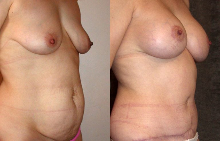 Mommy makeover abdominoplasty and breast augmentation