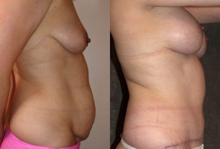 Mommy makeover abdominoplasty and breast augmentation - 2