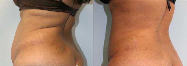 Abdominoplasty and liposuction of back and upper abdomen - 1