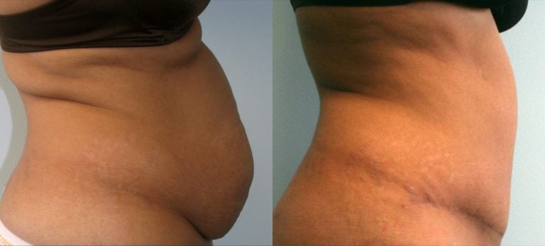 Abdominoplasty and liposuction of back and upper abdomen - 2