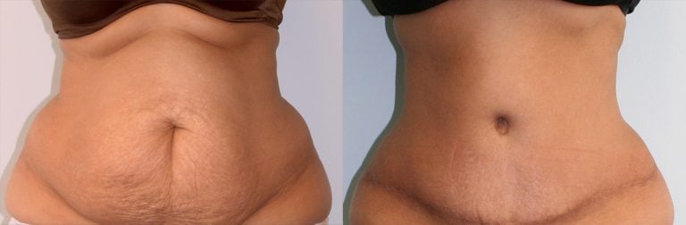 Abdominoplasty and liposuction of back and upper abdomen - 3