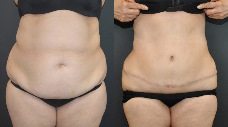 Liposuction of back and bra fat at same time as tummy-tuck - 2