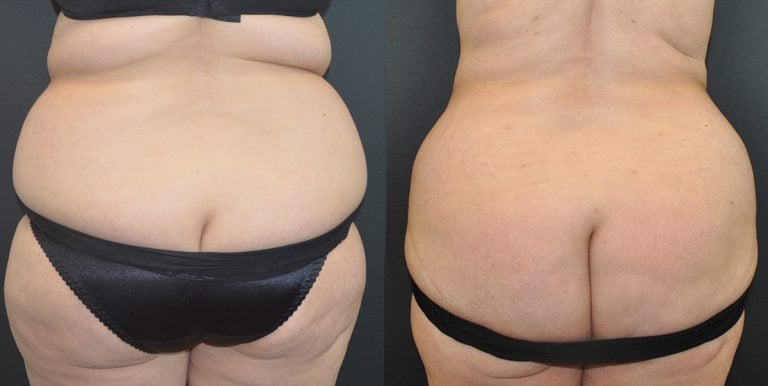Liposuction of back and bra fat at same time as tummy-tuck - 3