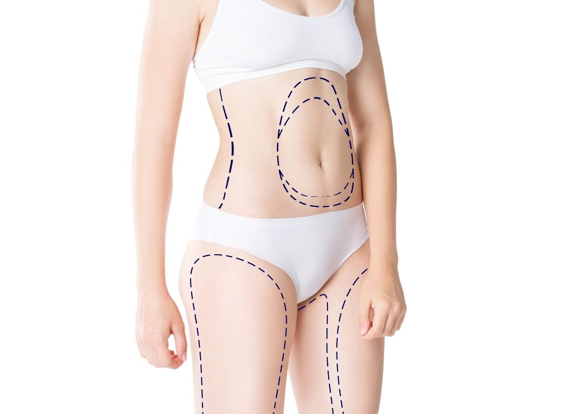 How Much Weight Is Lost During Tummy Tuck in Norwalk CT