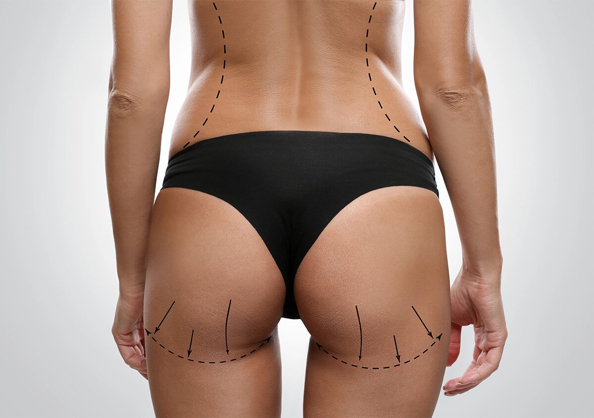 Butt Enhancement Injections in Norwalk CT Area