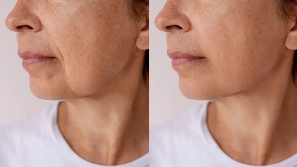 Side-by-side close-up of a woman’s lower face and neck showing two similar profile views.