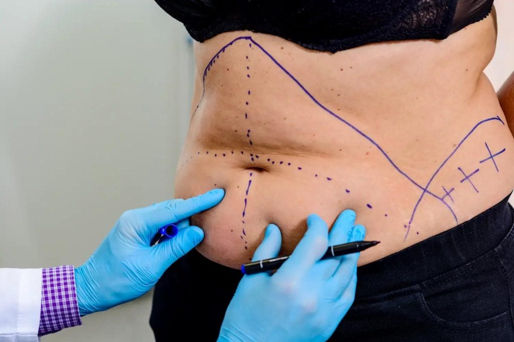 Doctor marking a woman’s abdomen with surgical lines before a liposuction procedure.