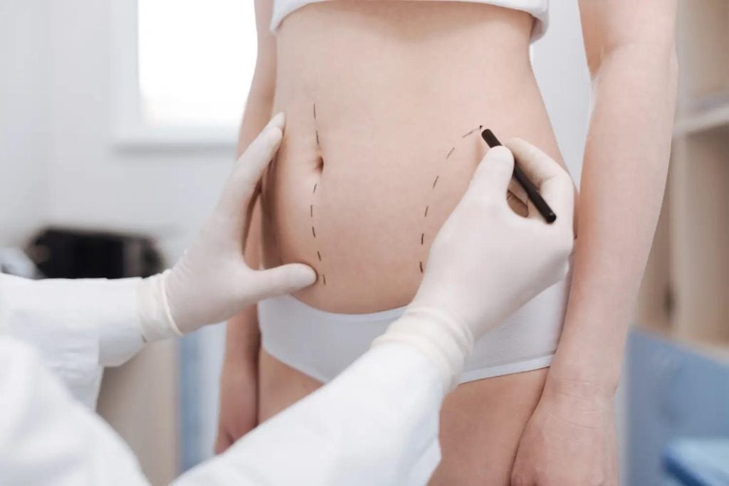 Doctor marking a woman’s abdomen with dotted lines during a tummy tuck consultation.
