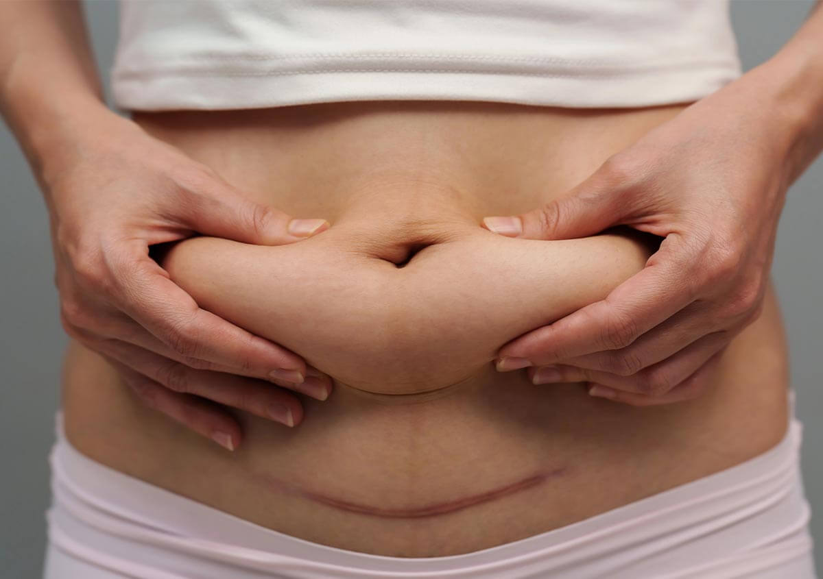 What you need to know about mommy makeover treatment following C-section surgery