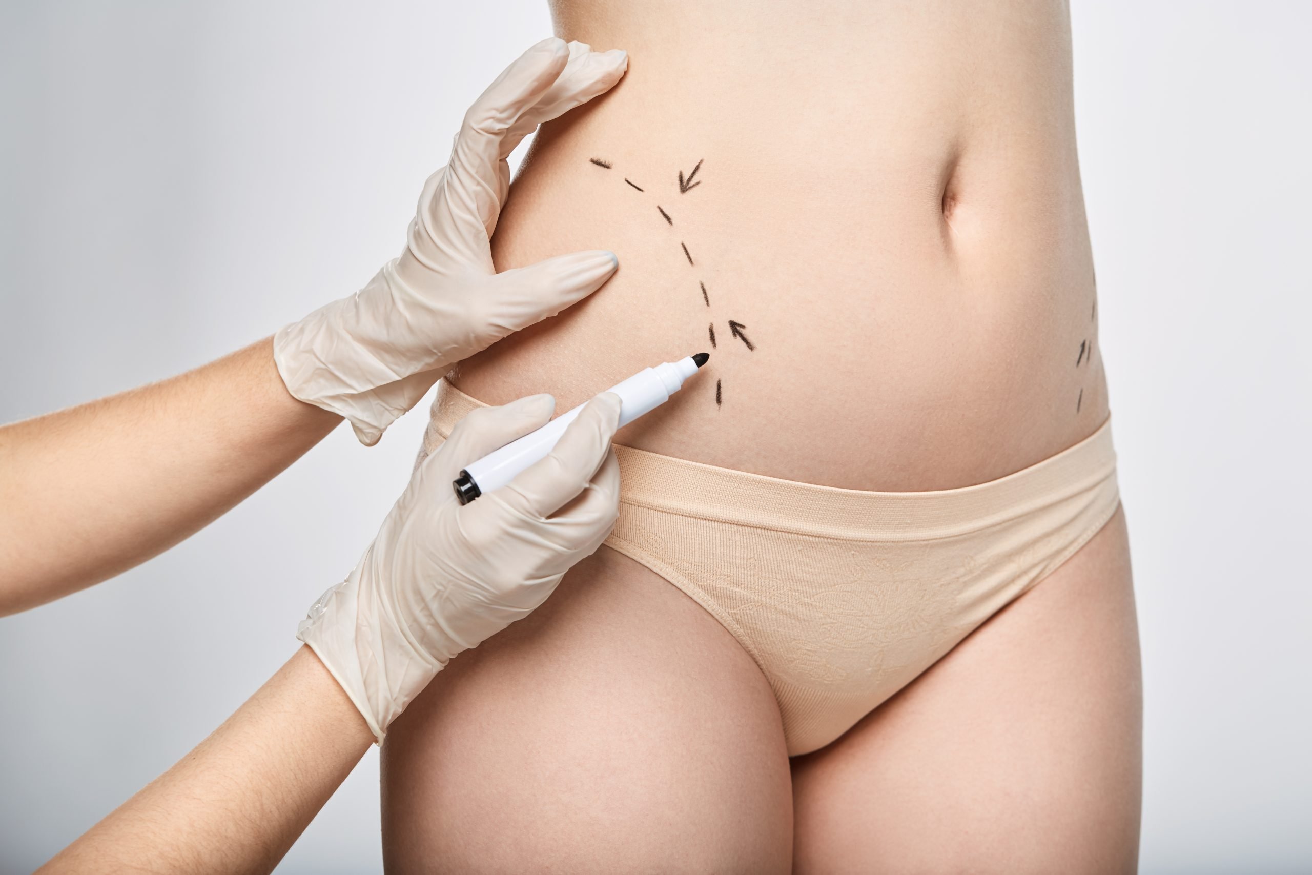 Gloved hands draw contour markings on lower abdomen and hip area
