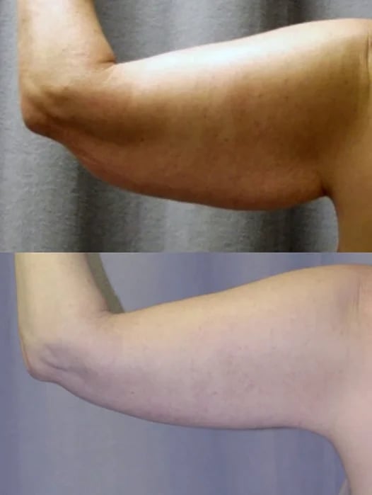 Arm lift before and after — upper arm contour, Kirwan Plastic Surgery