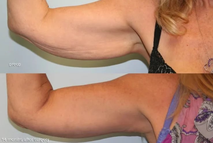 Arm lift before and 14 months after surgery, Kirwan Plastic Surgery