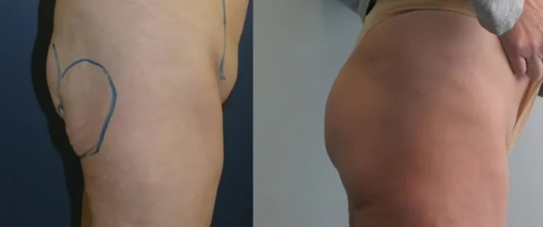 Brazilian Butt Lift before and after with surgical markings, Kirwan Plastic Surgery