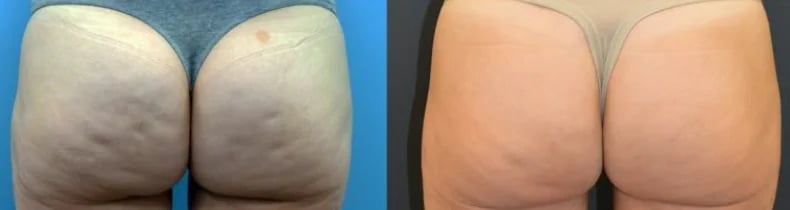 Brazilian Butt Lift before and after result, Kirwan Plastic Surgery