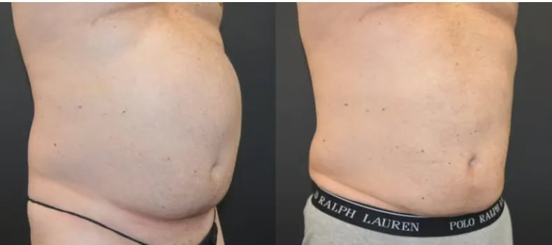 BodyTite with liposuction before and after — abdomen, Kirwan Plastic Surgery