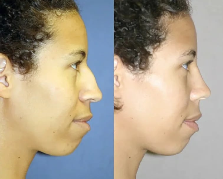 Ethnic rhinoplasty before and after — nose profile, Kirwan Plastic Surgery