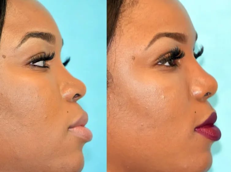 Ethnic rhinoplasty before and after result, Kirwan Plastic Surgery