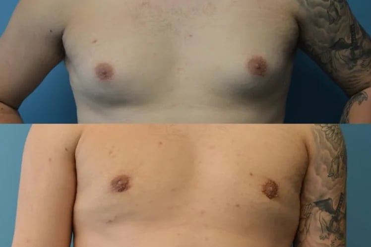 Gynecomastia surgery before and after — male chest, Kirwan Plastic Surgery