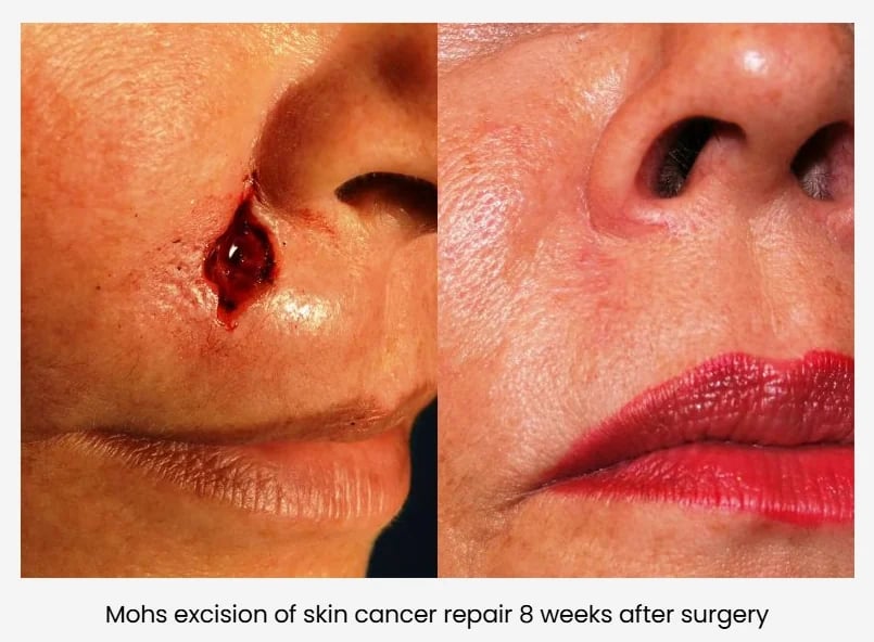 Mohs excision of skin cancer and repair 8 weeks after surgery, Kirwan Plastic Surgery