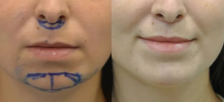Chin augmentation before and after with surgical markings, Kirwan Plastic Surgery