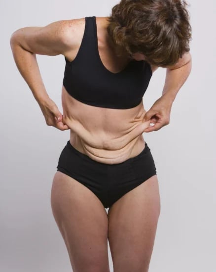 Loose abdominal skin remaining after major weight loss, before body lift surgery