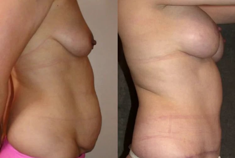 Mommy makeover before and after — abdomen and breast profile, Kirwan Plastic Surgery
