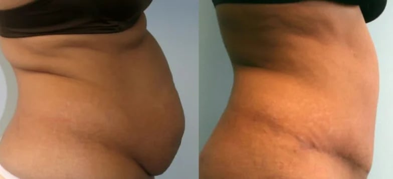 Mommy makeover before and after — abdominal contour, Kirwan Plastic Surgery