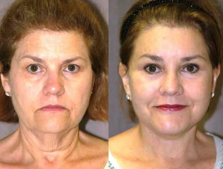 Neck lift before and after — jawline and neck contour, Kirwan Plastic Surgery